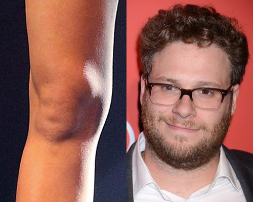 Miley Cyrus’ Kneecap Looks Like Seth Rogen’s Face